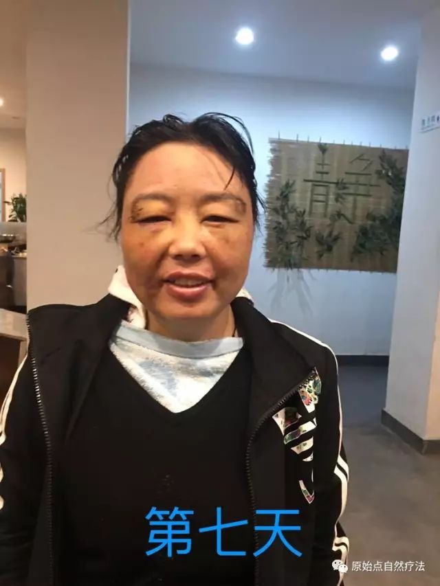 调理车祸案例 调理车祸案例