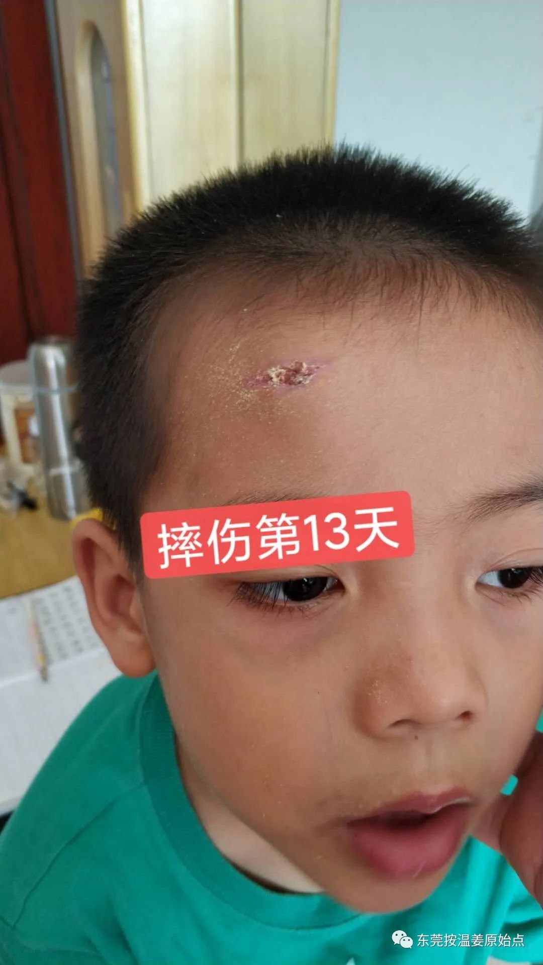 摔伤伤口大约长2CM深0.5CM,未缝针 摔伤伤口大约长2CM深0.5CM,未缝针