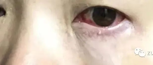 案例分享：原始点调理内风湿性关节炎、早期肝硬化的案例-原始点全球同学网