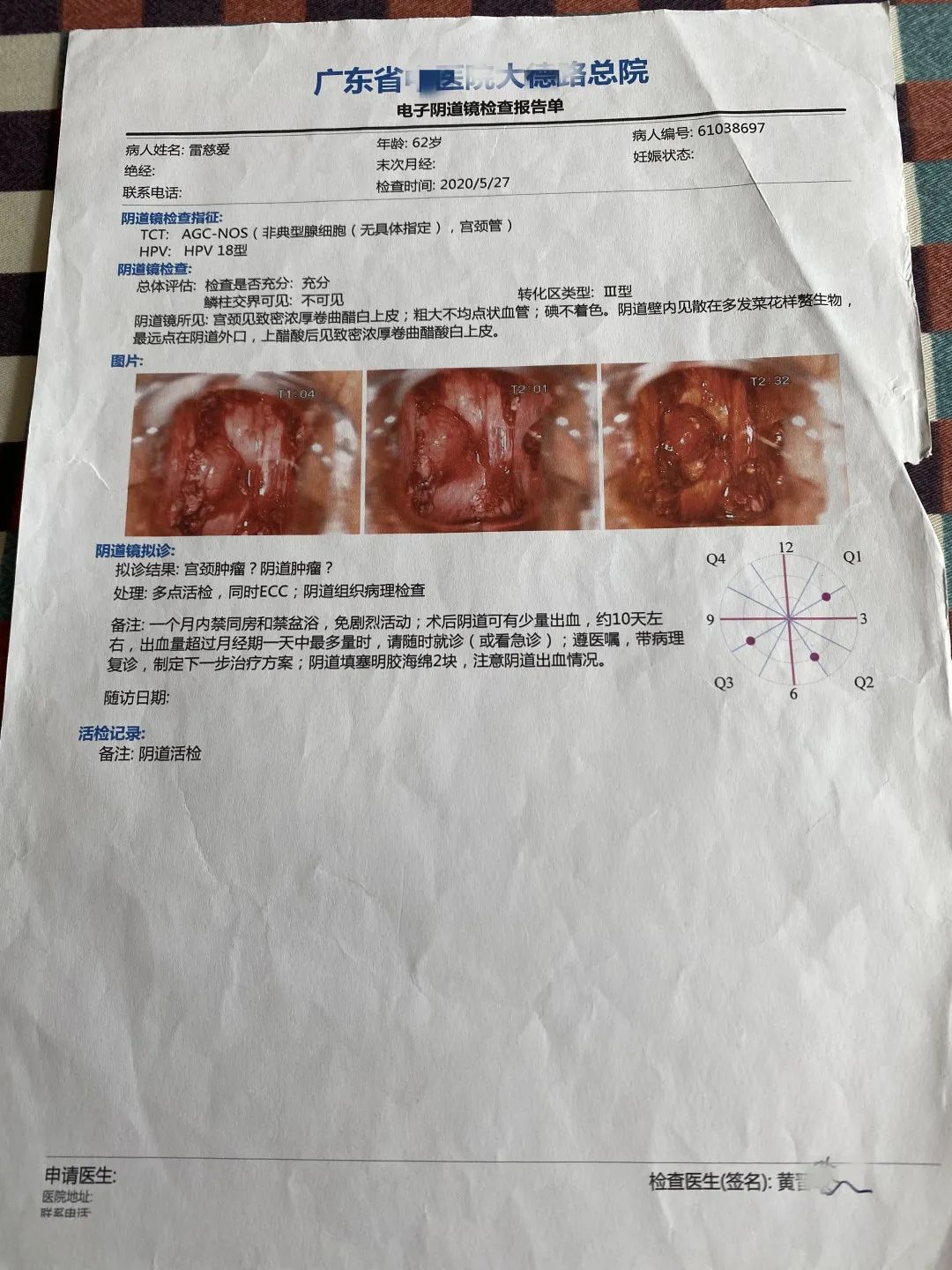 原始点调理宫颈腺癌及全身多处疼痛案例 原始点调理宫颈腺癌及全身多处疼痛案例
