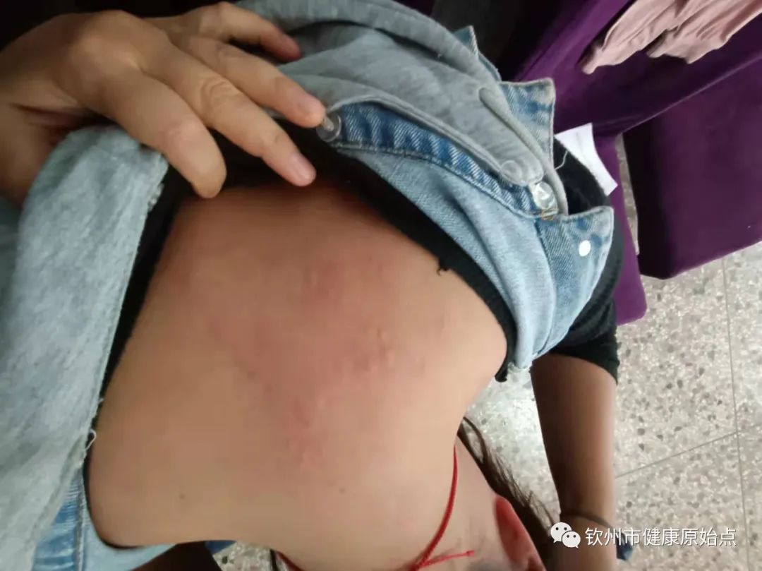 荨麻疹、手麻案例