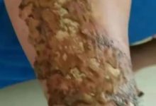 腿部烫伤，经常觉得累、老想睡觉、手脚冰凉、大便不成型案例-原始点全球同学网