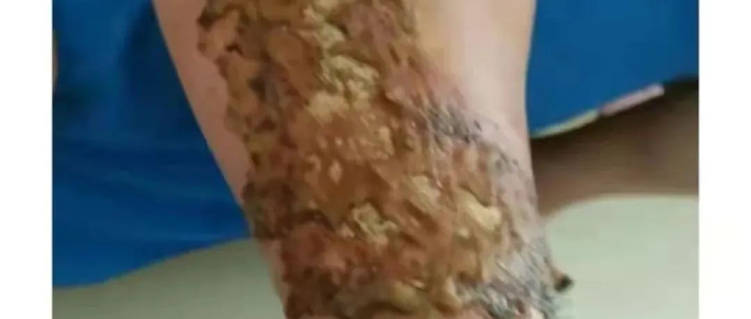 腿部烫伤，经常觉得累、老想睡觉、手脚冰凉、大便不成型案例-原始点全球同学网