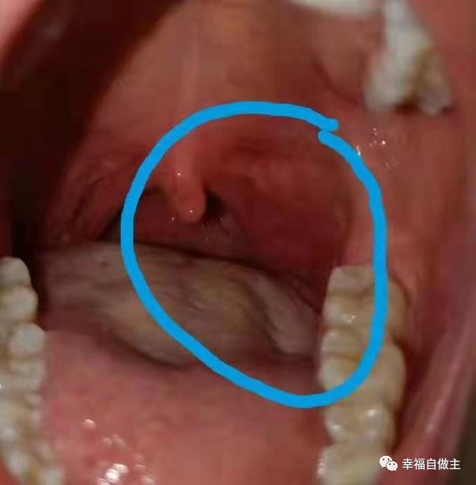 呼吸道感染、扁桃体化脓案例! 呼吸道感染、扁桃体化脓案例!