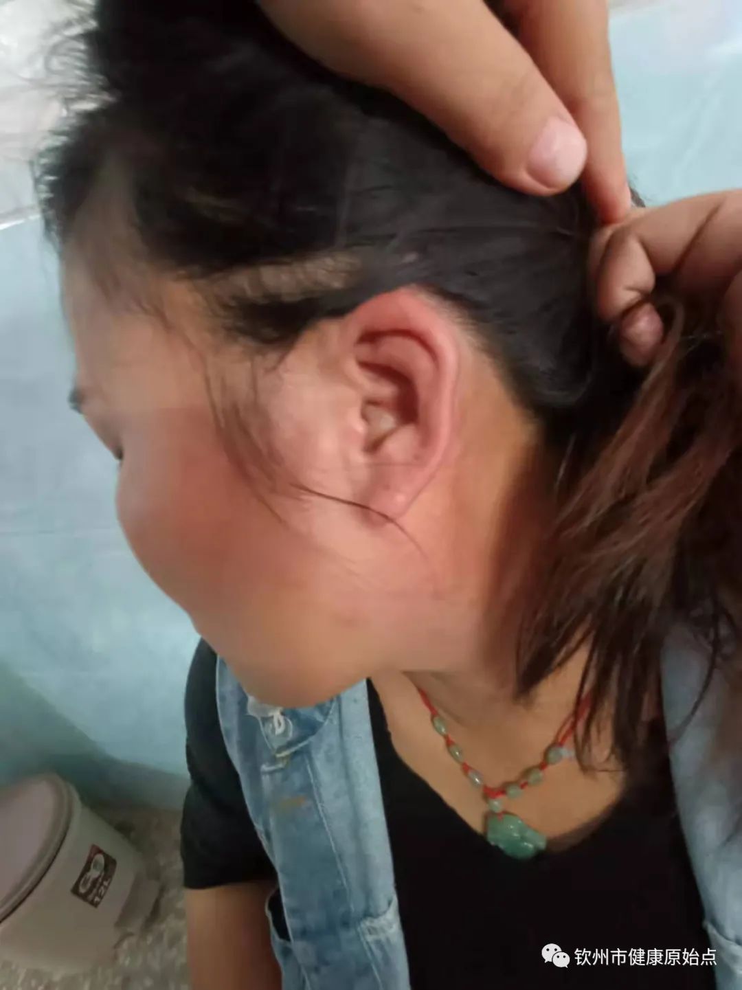 荨麻疹、手麻案例