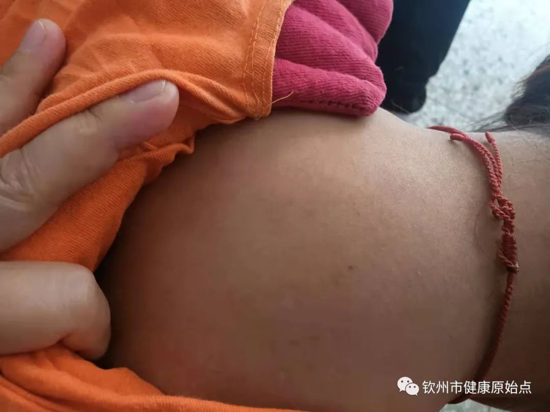 荨麻疹、手麻案例