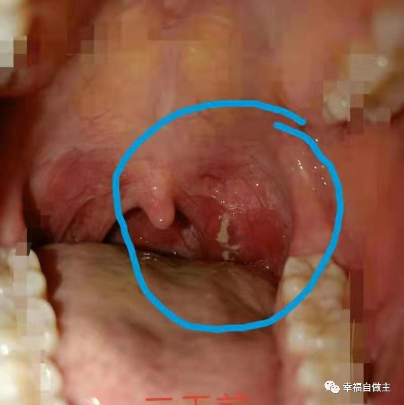 呼吸道感染、扁桃体化脓案例! 呼吸道感染、扁桃体化脓案例!