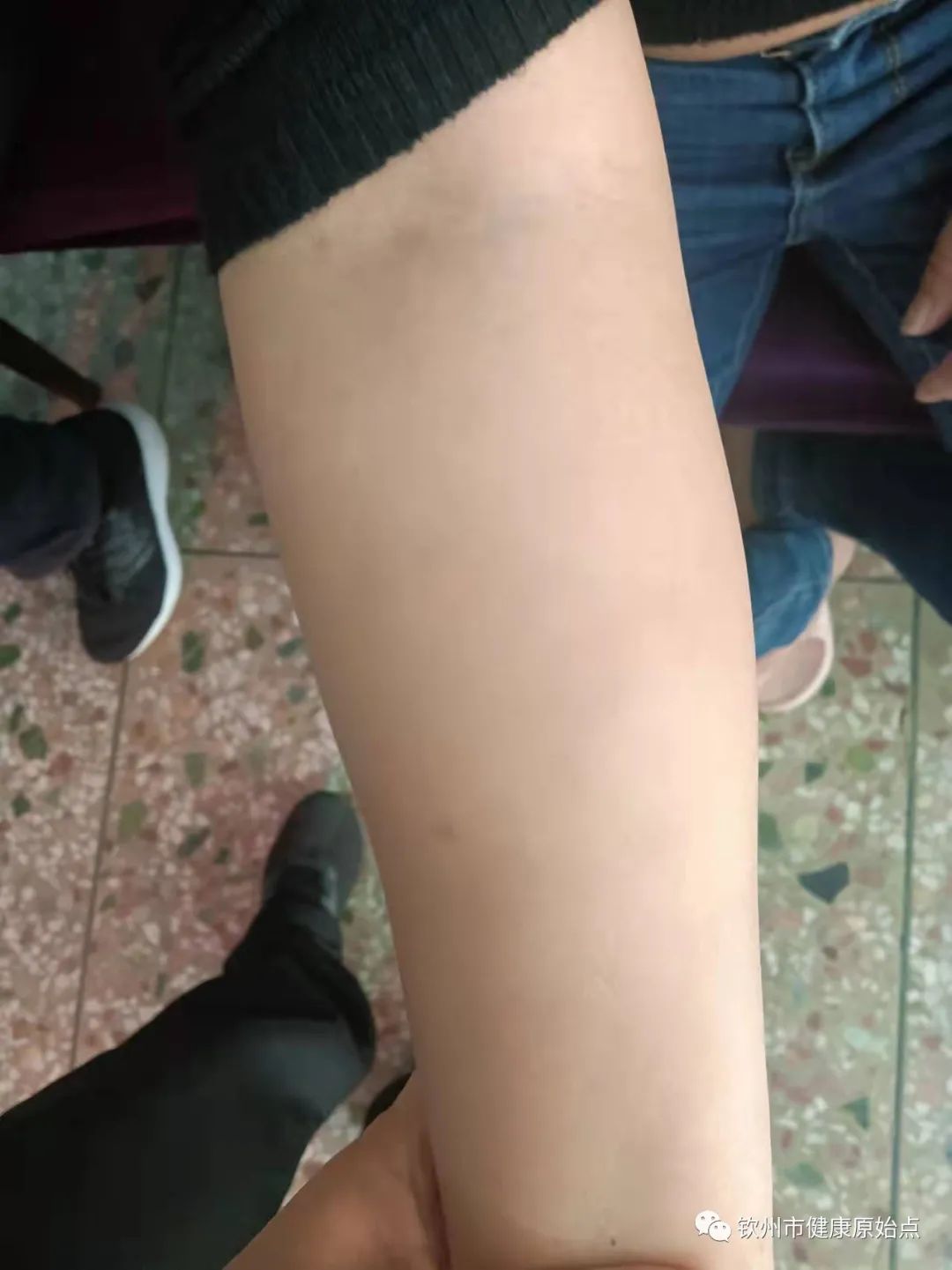 荨麻疹、手麻案例