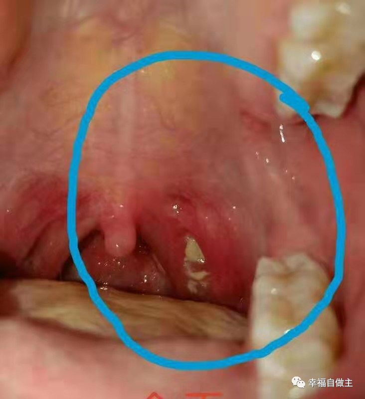 呼吸道感染、扁桃体化脓案例! 呼吸道感染、扁桃体化脓案例!