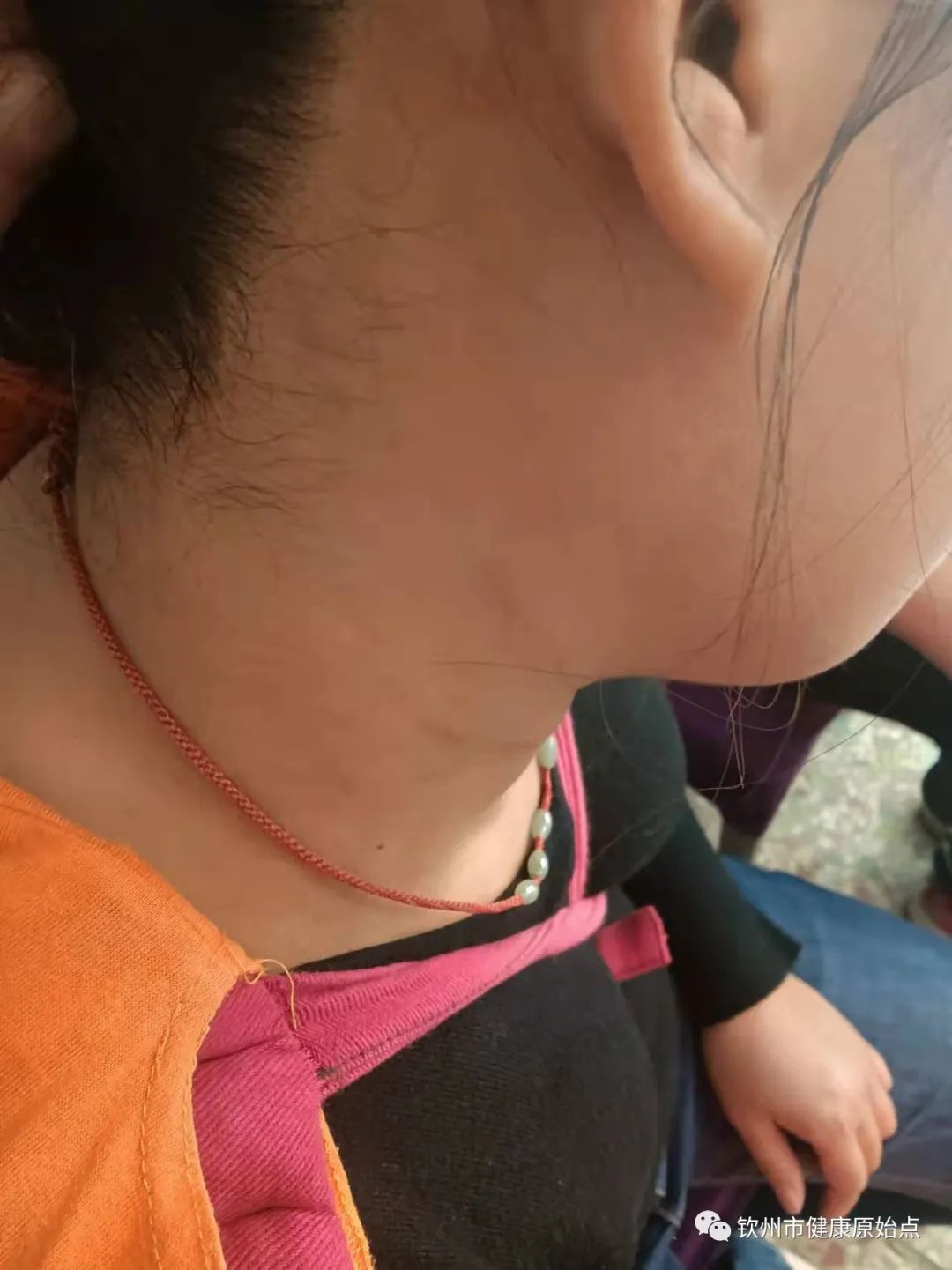 荨麻疹、手麻案例