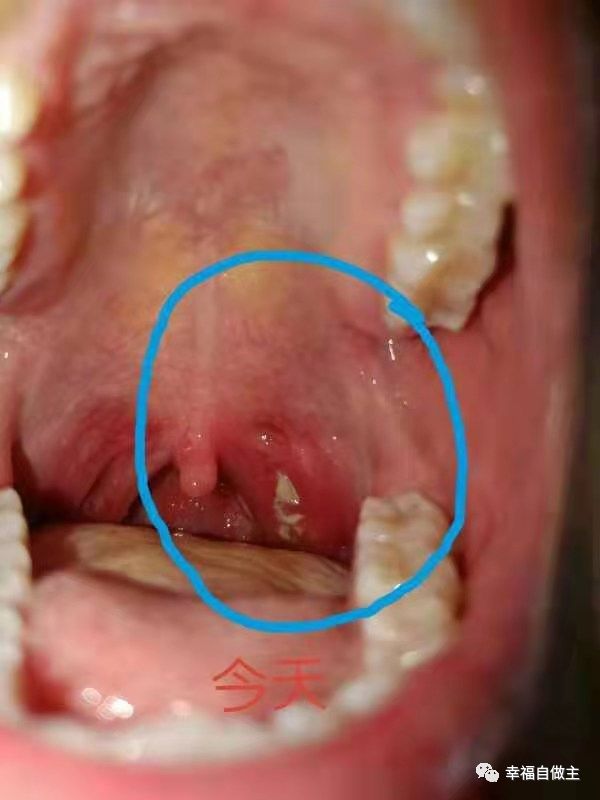 呼吸道感染、扁桃体化脓案例! 呼吸道感染、扁桃体化脓案例!
