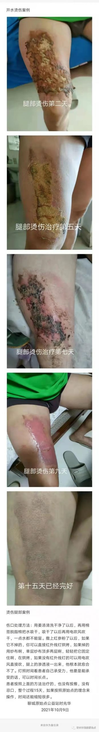 腿部烫伤,经常觉得累、老想睡觉、手脚冰凉、大便不成型案例 腿部烫伤,经常觉得累、老想睡觉、手脚冰凉、大便不成型案例