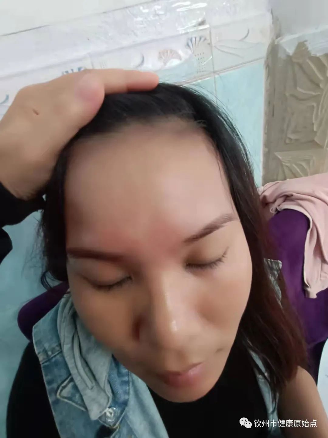 荨麻疹、手麻案例