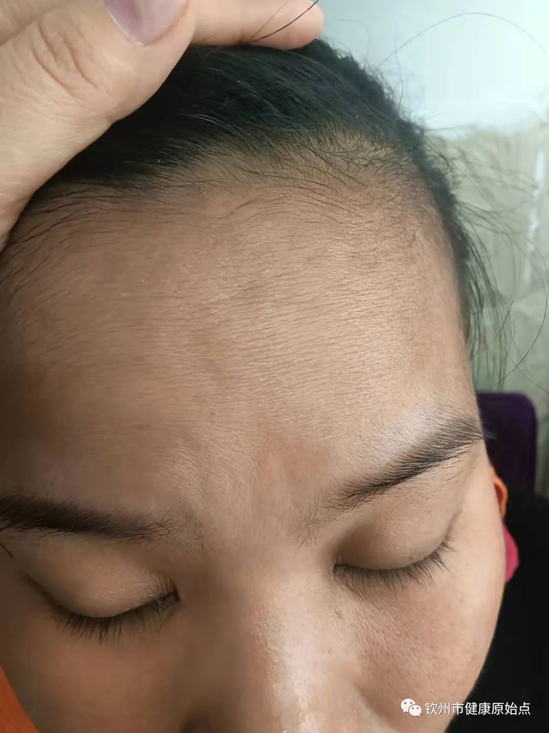 荨麻疹、手麻案例