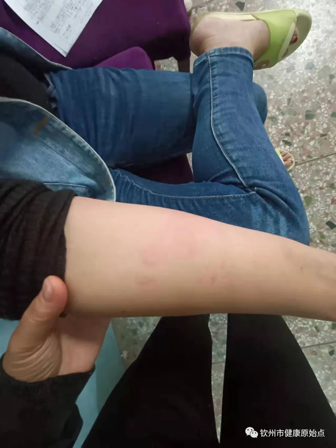 荨麻疹、手麻案例