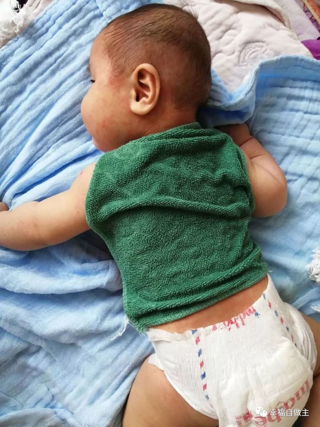 婴儿发烧和生疹子案例 婴儿发烧和生疹子案例