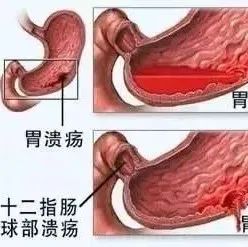 十二指肠球部溃疡＋胃溃疡 案例-原始点全球同学网