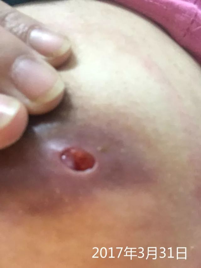 原始点调理乳房溃烂：一位德国媳妇飞越半球的原始点求医经历 - 乳腺增生  乳腺癌 - 佛山市愿天下无痛健康管理服务有限公司