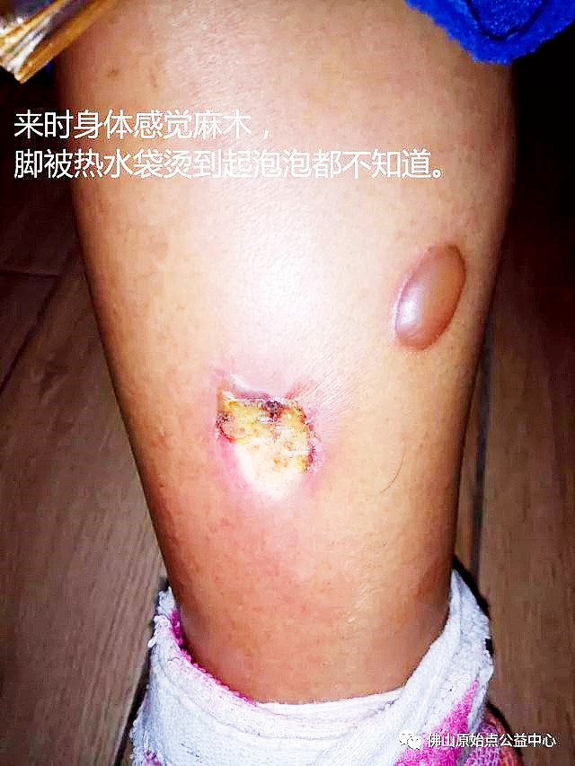 原始点调理全身麻木疼痛肿胀案例 - 身体  五脏六腑 - 佛山市愿天下无痛健康管理服务有限公司