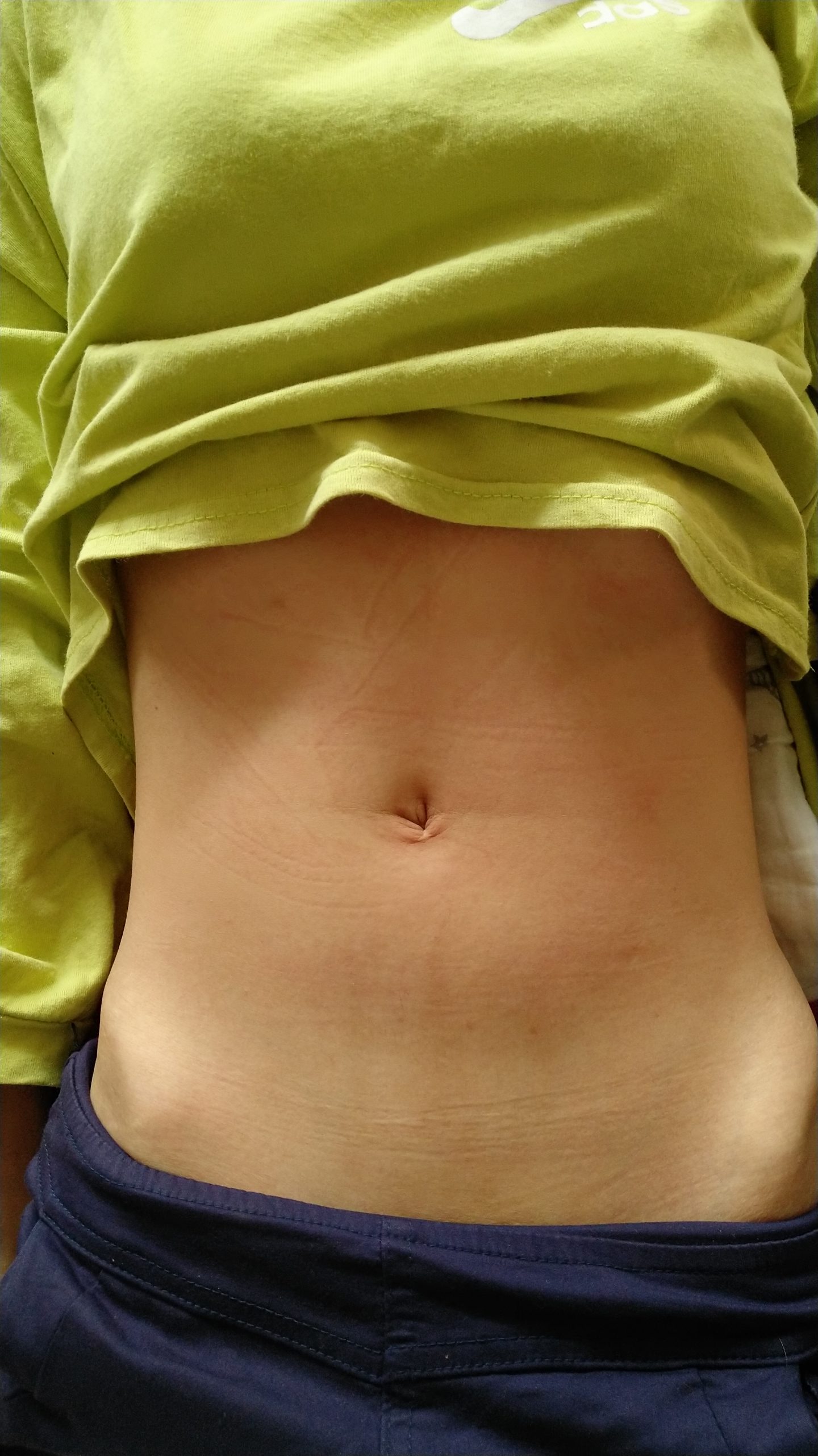 原始点调理卵巢囊肿案例 - 妇产   - 佛山市愿天下无痛健康管理服务有限公司