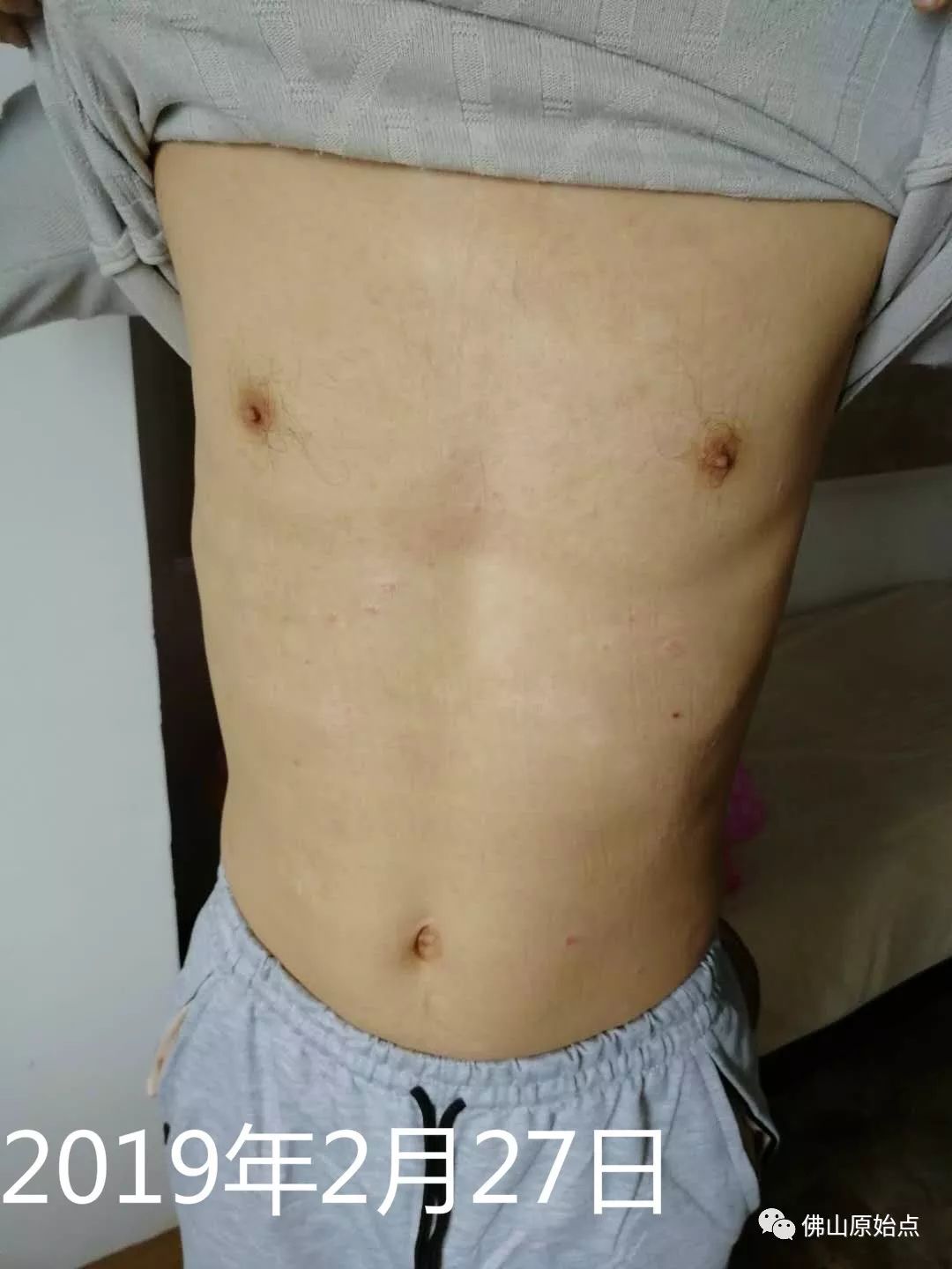 原始点调理牛皮癣案例 - 皮肤 - 佛山市愿天下无痛健康管理服务有限公司