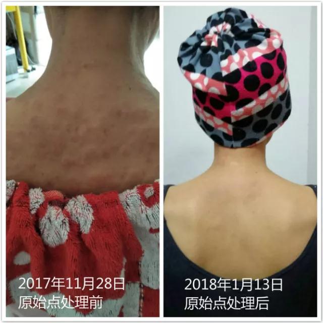 原始点调理附子中毒：细节决定成败 - 皮肤 - 佛山市愿天下无痛健康管理服务有限公司