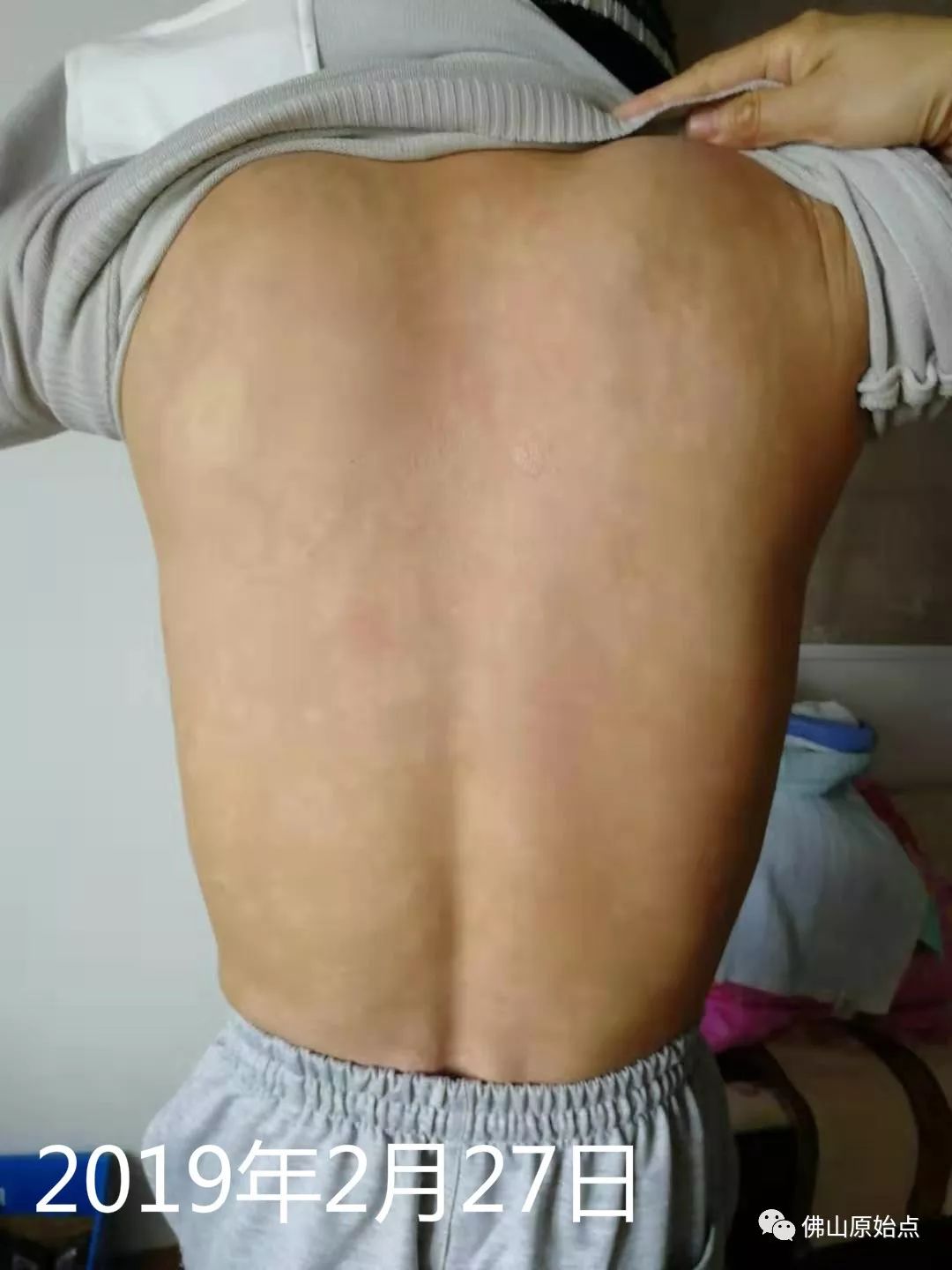 原始点调理牛皮癣案例 - 皮肤 - 佛山市愿天下无痛健康管理服务有限公司