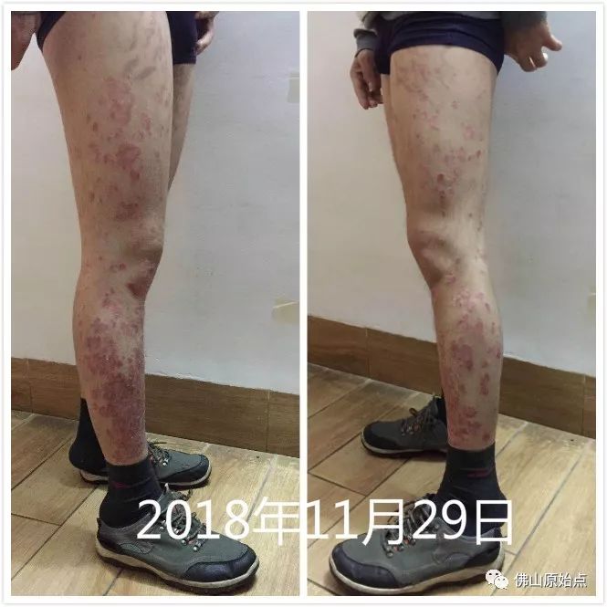 原始点调理牛皮癣案例 - 皮肤 - 佛山市愿天下无痛健康管理服务有限公司