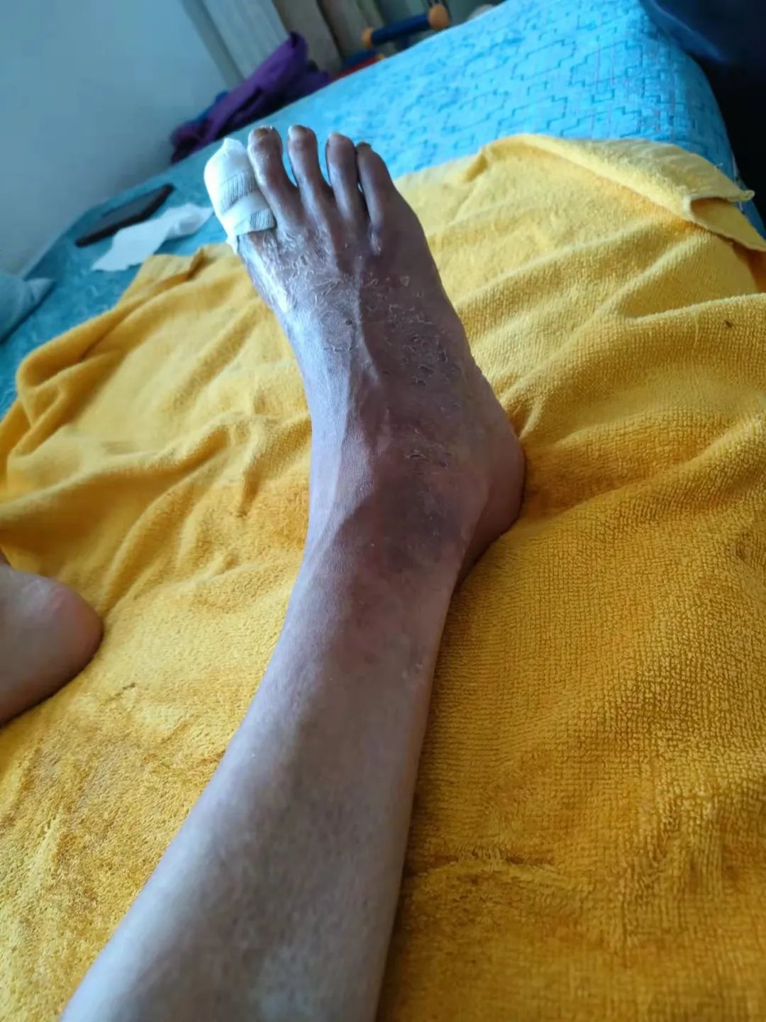 糖尿病案例 糖尿病案例