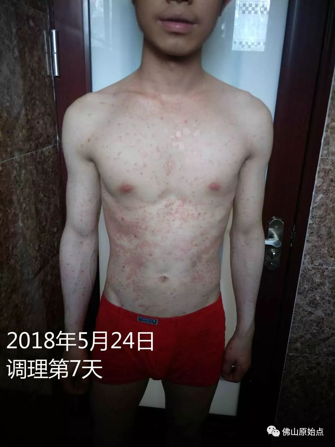 原始点调理严重牛皮癣及静脉曲张：84天完好如初 - 皮肤 - 佛山市愿天下无痛健康管理服务有限公司