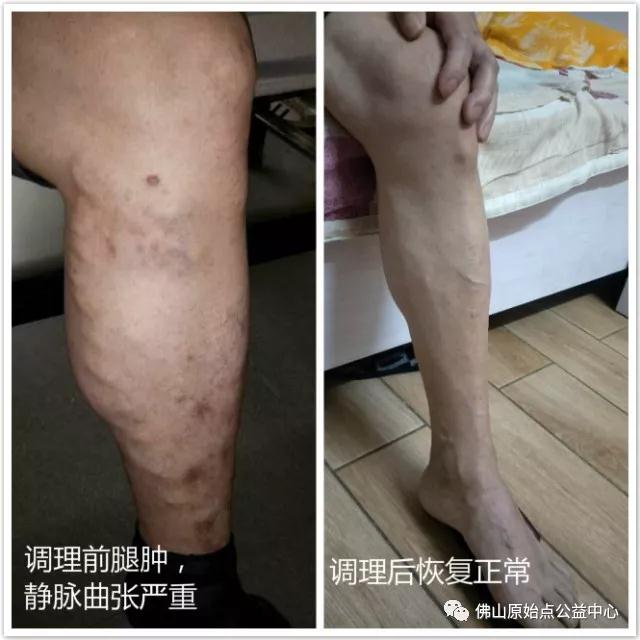 原始点调理全身麻木疼痛肿胀案例 - 身体  五脏六腑 - 佛山市愿天下无痛健康管理服务有限公司