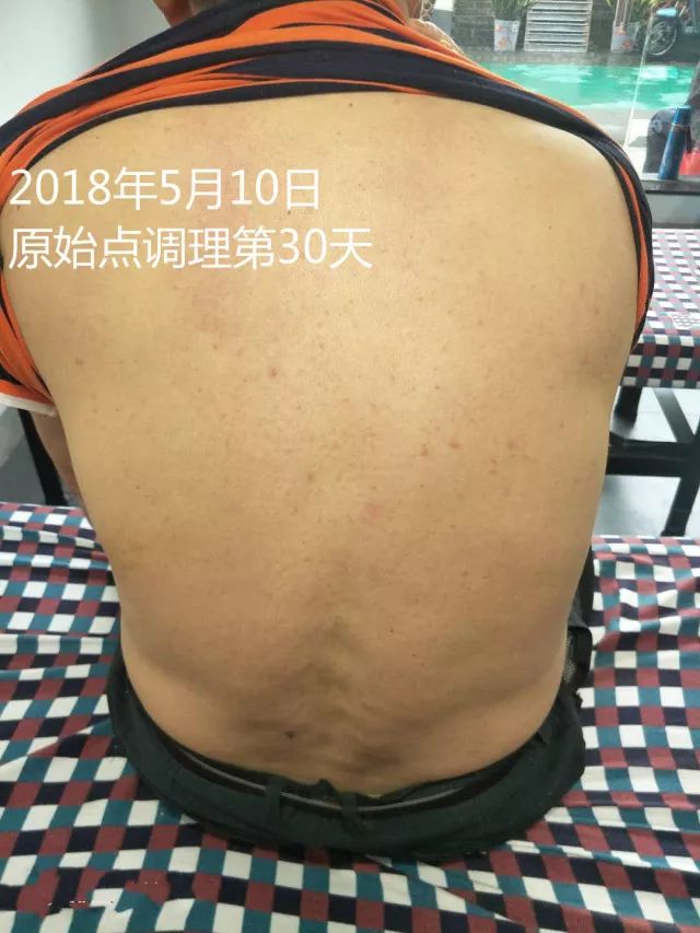 原始点调理十五年病史牛皮癣：30天大变样 - 皮肤 - 佛山市愿天下无痛健康管理服务有限公司