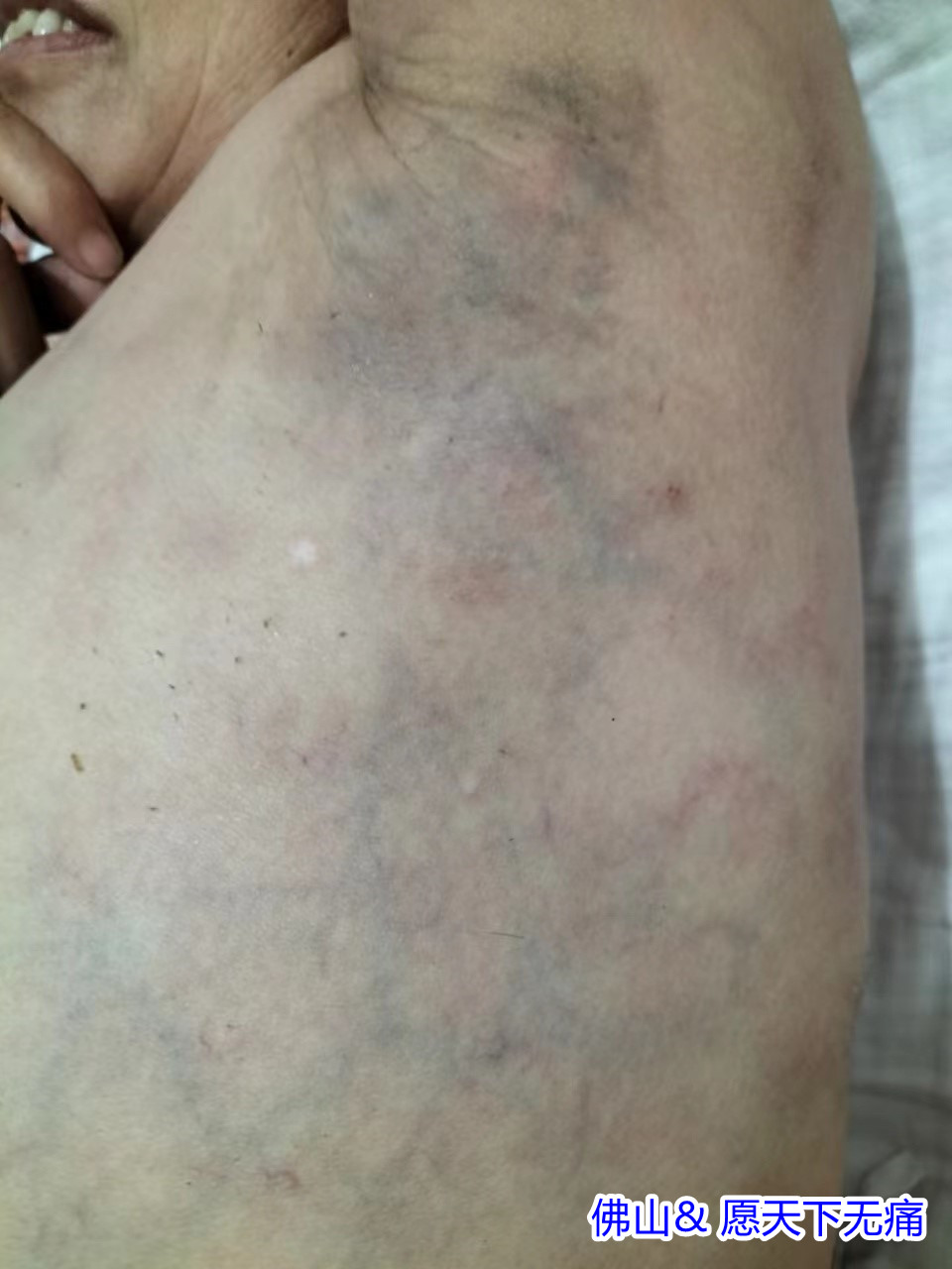 原始点腋下淤青静脉曲张结节，乳腺痛等多处疼痛案例(焦小爱) - 皮肤 - 佛山市愿天下无痛健康管理服务有限公司