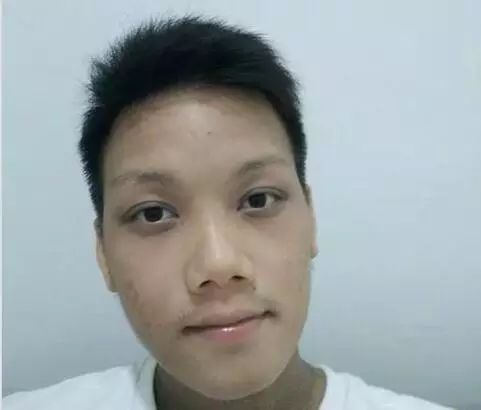 原始点21天调理23年严重湿疹案例 - 皮肤 - 佛山市愿天下无痛健康管理服务有限公司