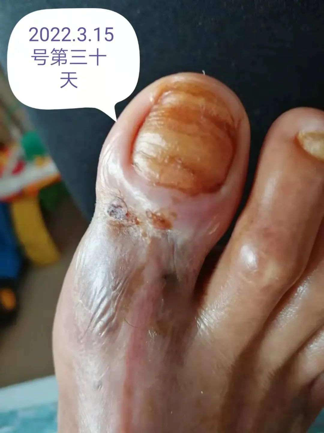 糖尿病案例 糖尿病案例