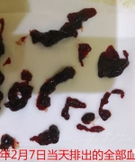 原始点调理排出死胎案例 - 妇产   - 佛山市愿天下无痛健康管理服务有限公司