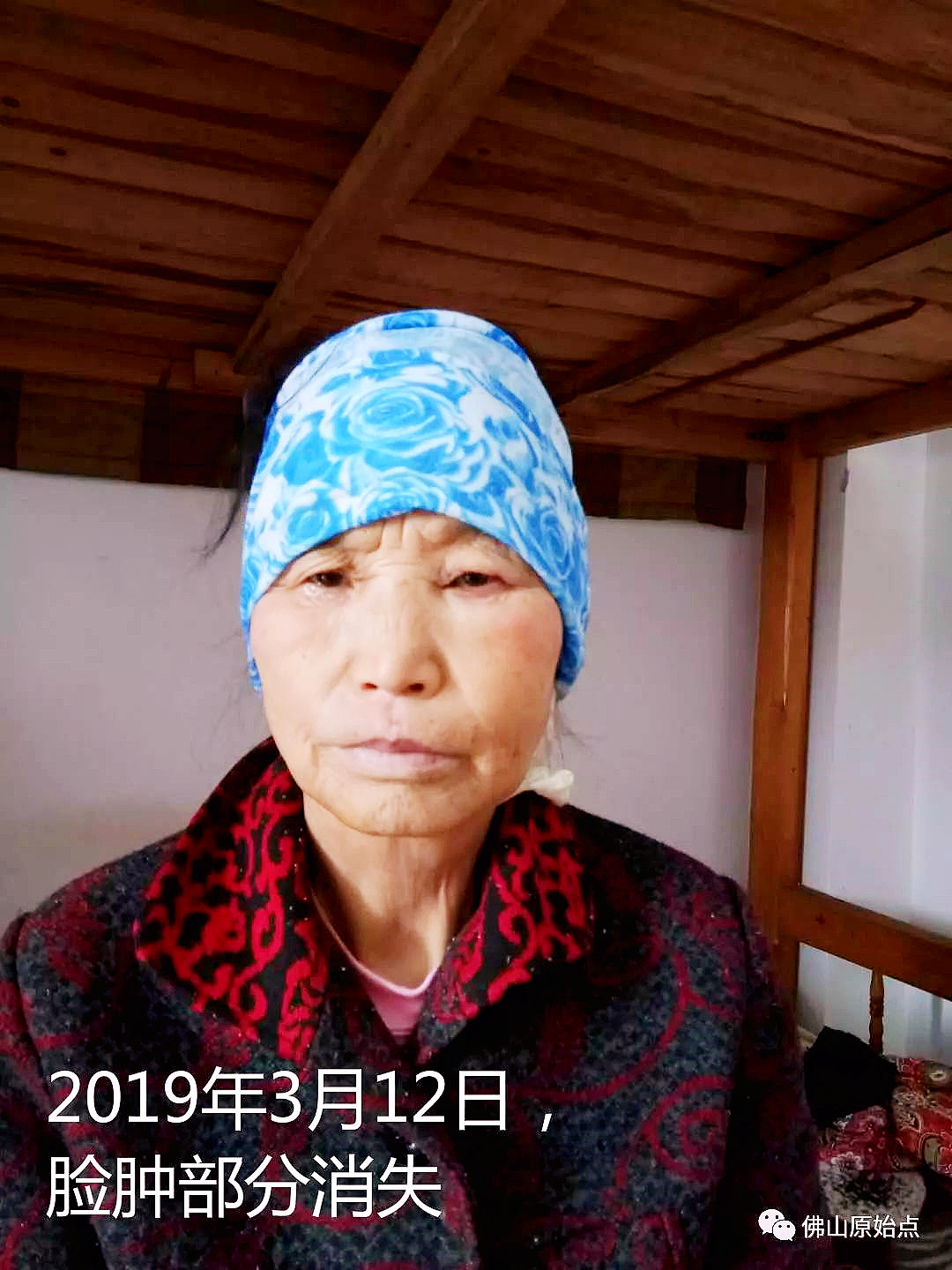 原始点调理牙痛案例 - 头颈  五官 - 佛山市愿天下无痛健康管理服务有限公司