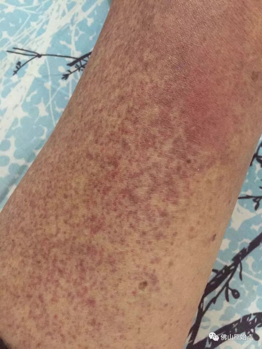 原始点调理肺肿瘤案例 - 肺结核  肺腺癌  肺癌 - 佛山市愿天下无痛健康管理服务有限公司