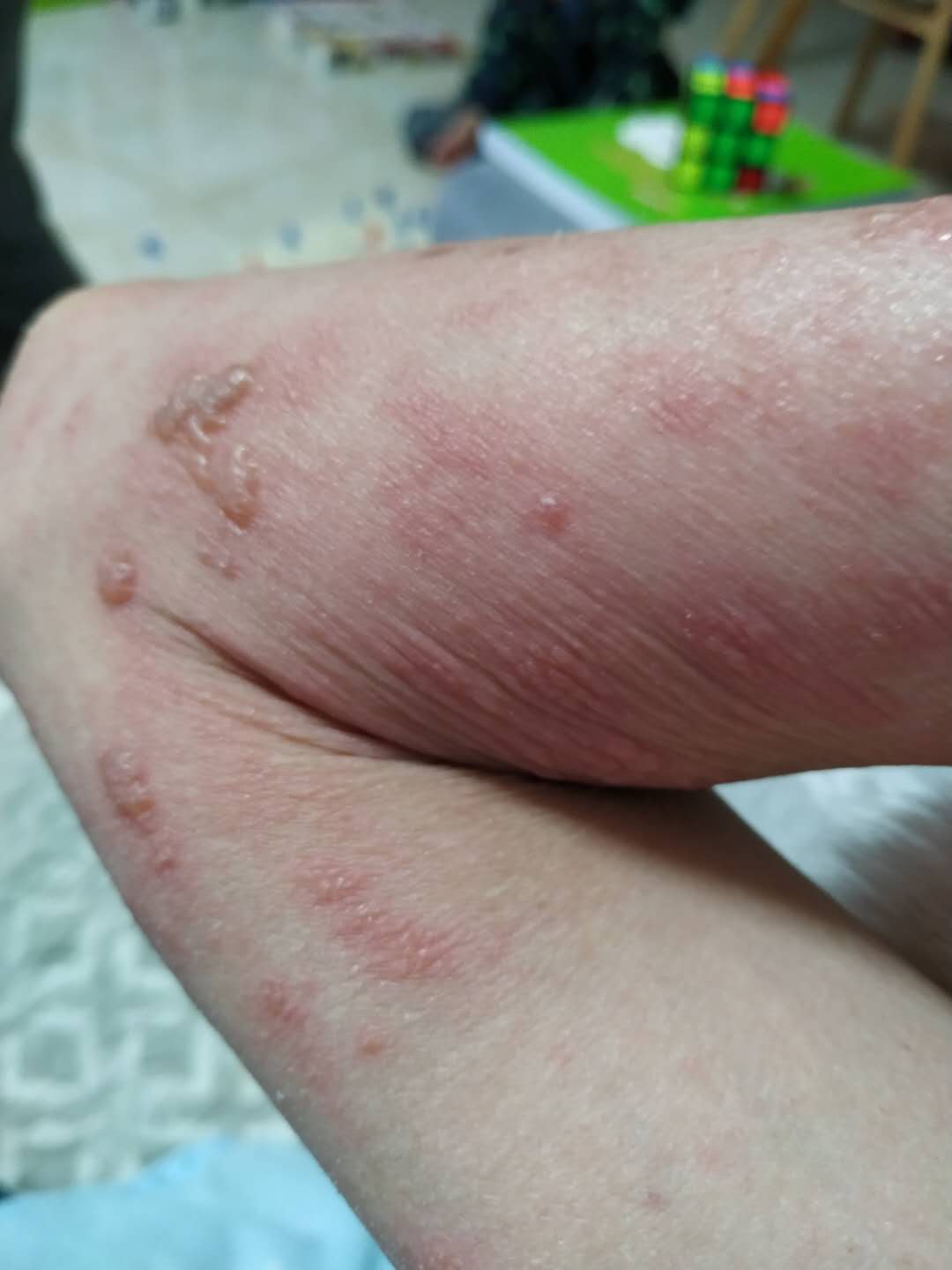 原始点调理红斑狼疮案例 - 皮肤 - 佛山市愿天下无痛健康管理服务有限公司