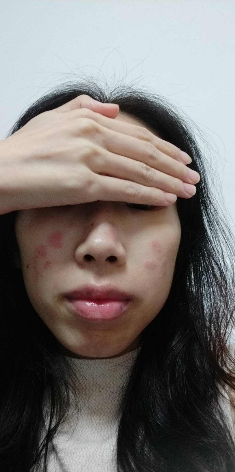 原始点调理红斑狼疮案例 - 皮肤 - 佛山市愿天下无痛健康管理服务有限公司