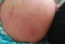 案例分享:原始点调理腿无力,无法下蹲以及消除“富贵包”的案例-原始点全球同学网