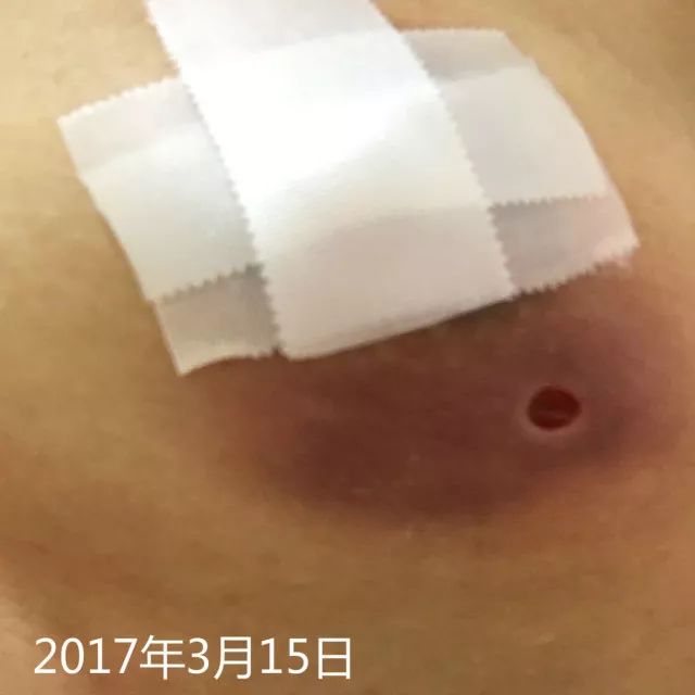 原始点调理乳房溃烂：一位德国媳妇飞越半球的原始点求医经历 - 乳腺增生  乳腺癌 - 佛山市愿天下无痛健康管理服务有限公司