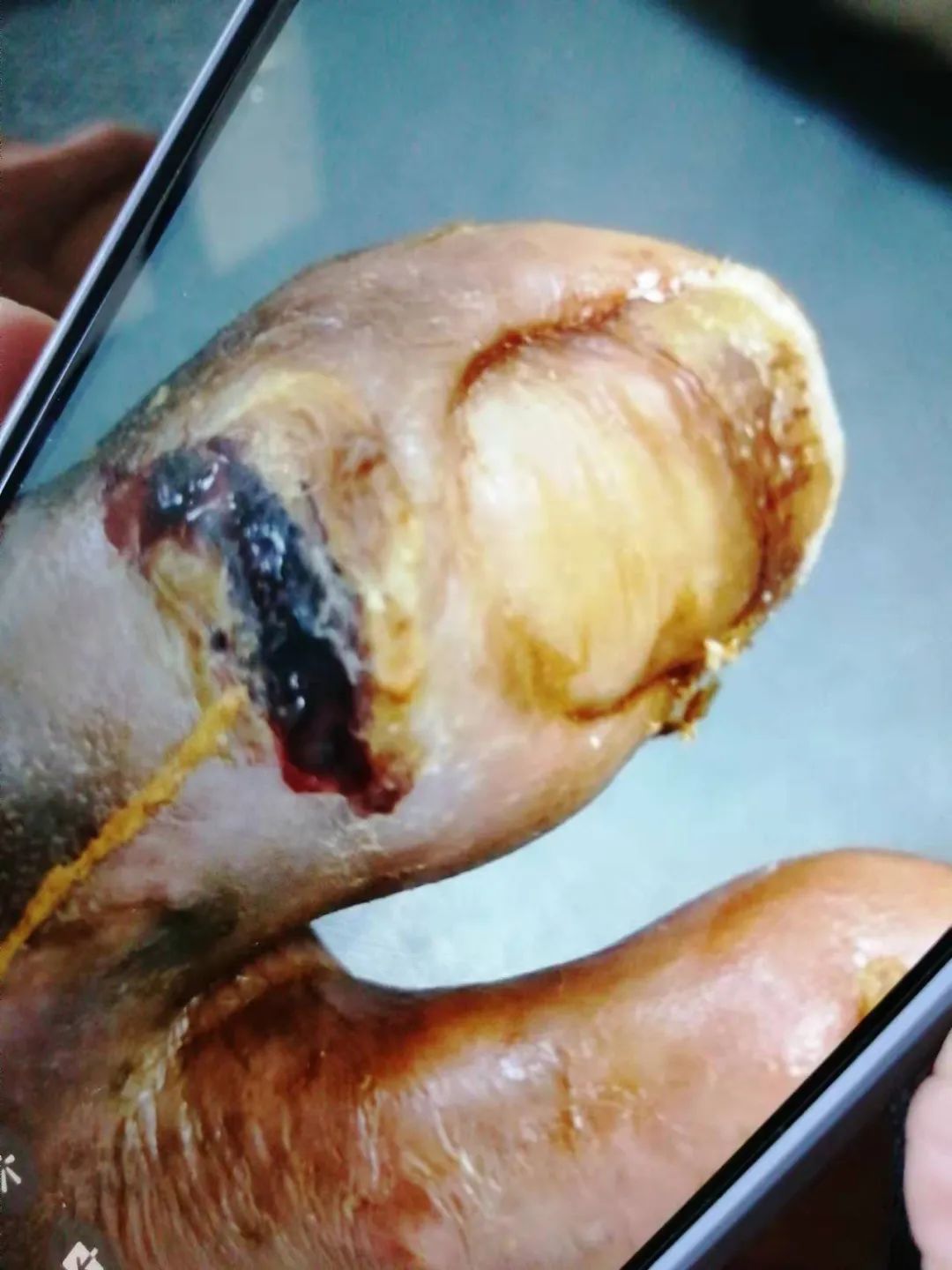 糖尿病案例 糖尿病案例