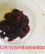 原始点调理排出死胎案例 - 妇产   - 佛山市愿天下无痛健康管理服务有限公司