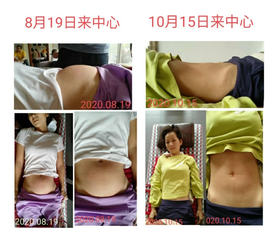 原始点调理卵巢囊肿案例 - 妇产   - 佛山市愿天下无痛健康管理服务有限公司