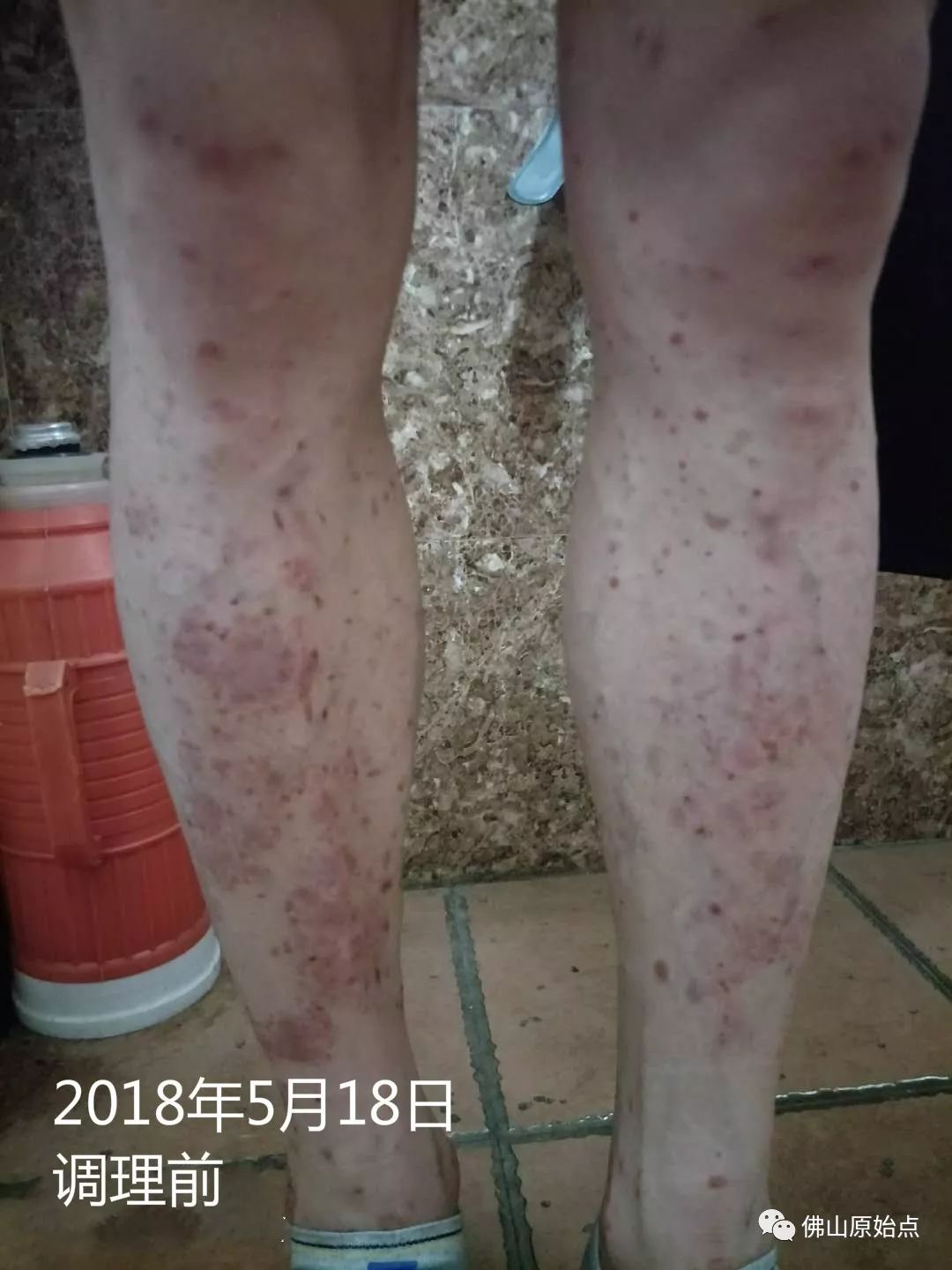 原始点调理严重牛皮癣及静脉曲张：84天完好如初 - 皮肤 - 佛山市愿天下无痛健康管理服务有限公司-原始点全球同学网
