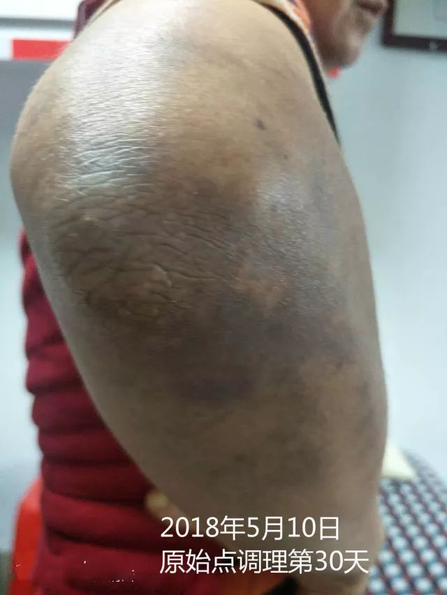 原始点调理十五年病史牛皮癣：30天大变样 - 皮肤 - 佛山市愿天下无痛健康管理服务有限公司