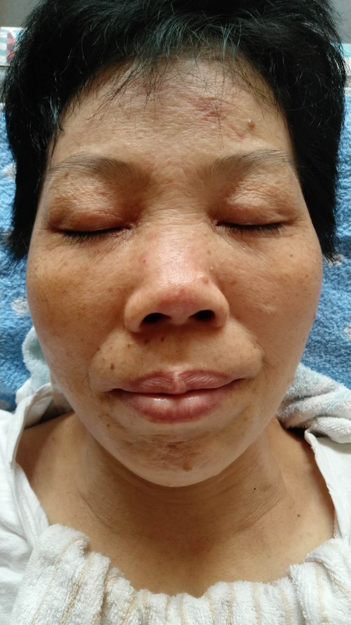 原始点调理鼻息肉案例 - 头颈 五官-原始点全球同学网