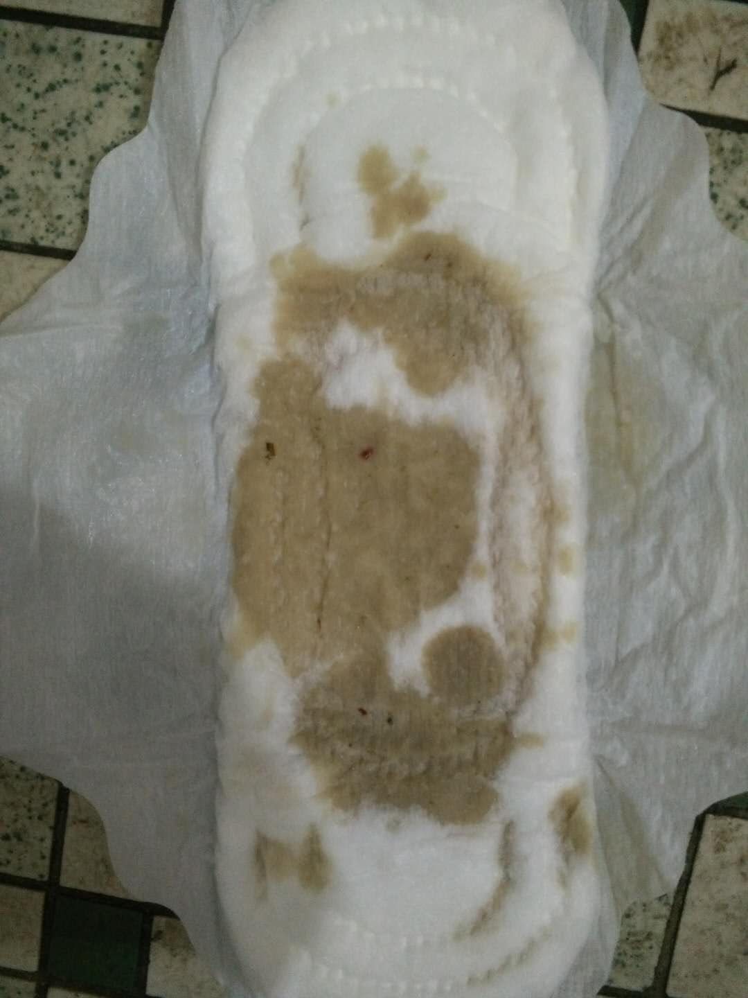 原始点调理卵巢囊肿案例 - 妇产   - 佛山市愿天下无痛健康管理服务有限公司