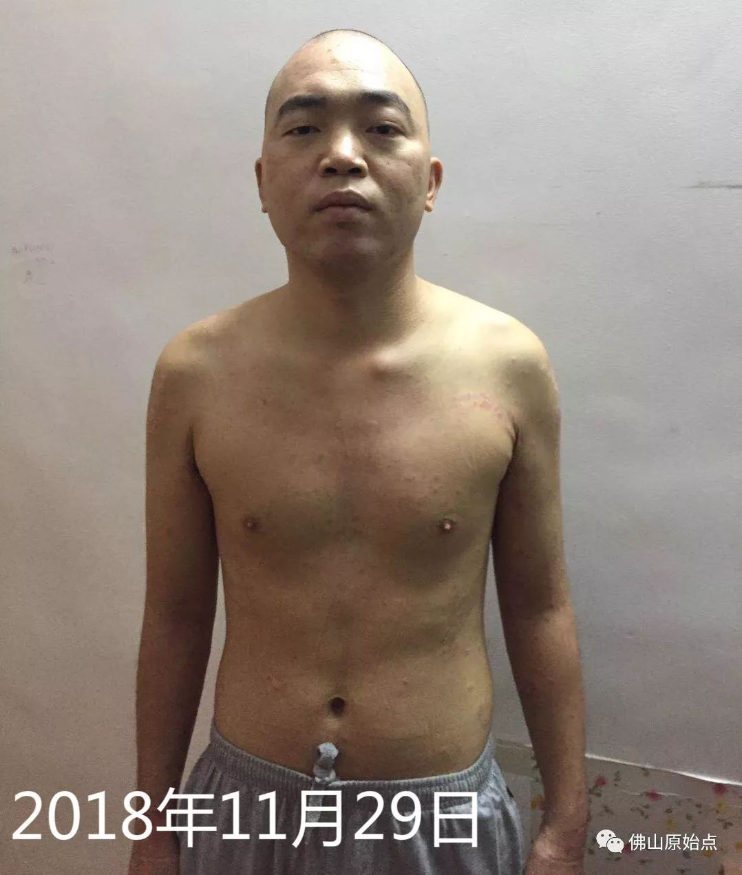 原始点调理牛皮癣案例 - 皮肤 - 佛山市愿天下无痛健康管理服务有限公司